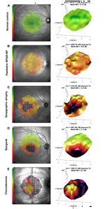 Microperimetry Hill of Vision and Volumetric Measures of Retinal Sensitivity