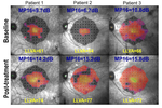 Approval of retinal gene therapies in the US and Europe based on visual acuity and microperimetry
